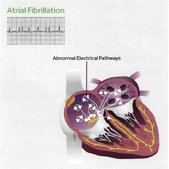 Atrial Fibrillation | Florida Electrophysiology Associates